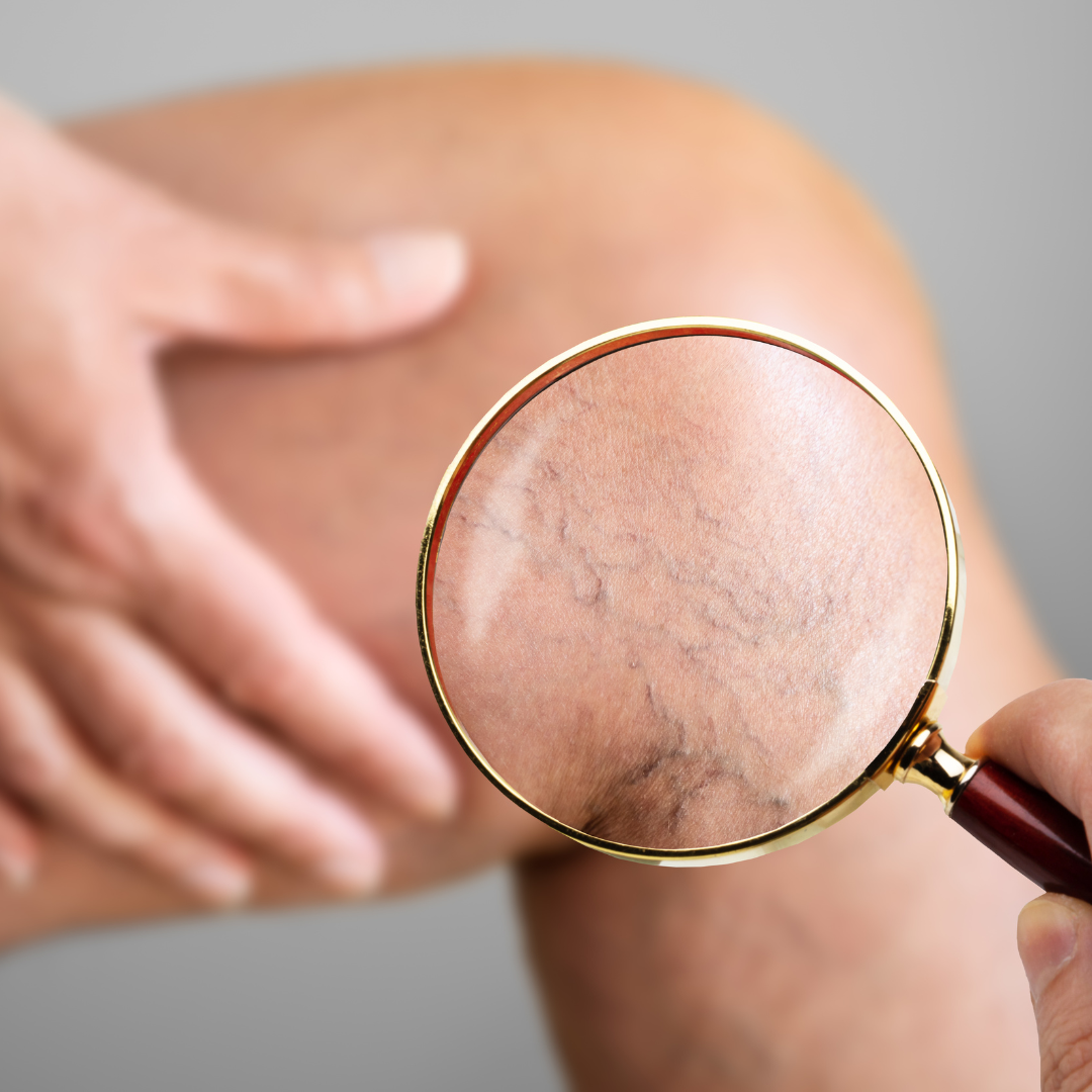 Conheça os tratamentos para vasinhos 